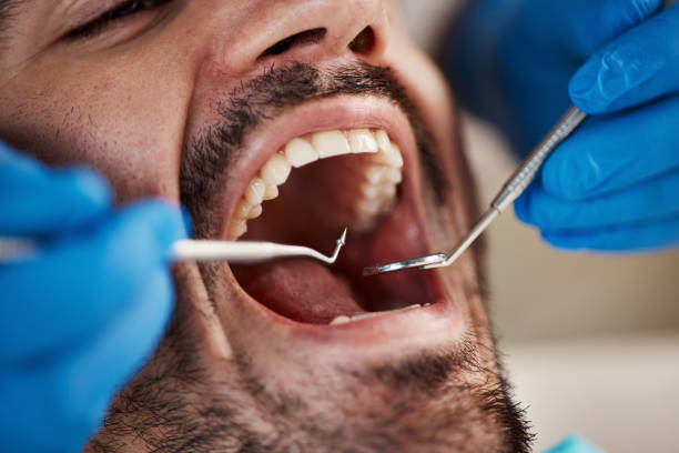Best Emergency Treatment for Dental Infections or Abscesses in Herald, CA